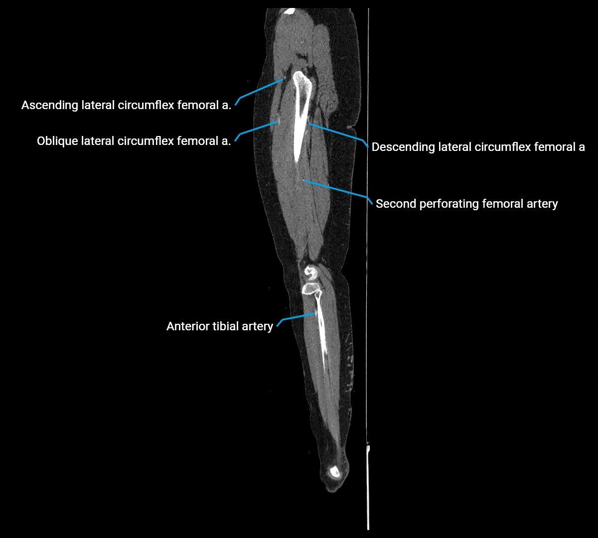 CTA lower limb sagittal cross sectional anatomy labelled image _57 (3).webp